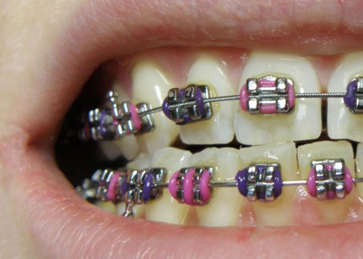 Types of Braces for Teeth