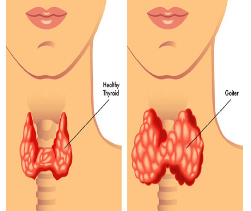 Hyperthyroidism Global Clinical Trials Review, H1, 2020