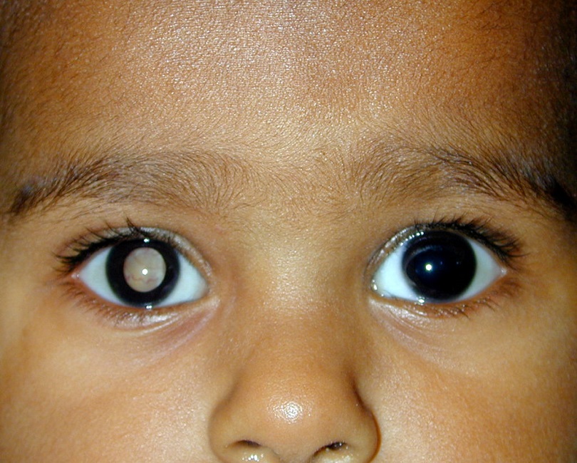 Retinoblastoma - Pipeline Review, H1 2020