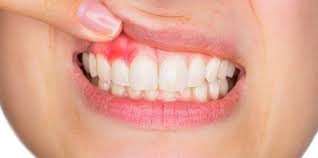 Gingivitis Global Clinical Trials Review, H1, 2020