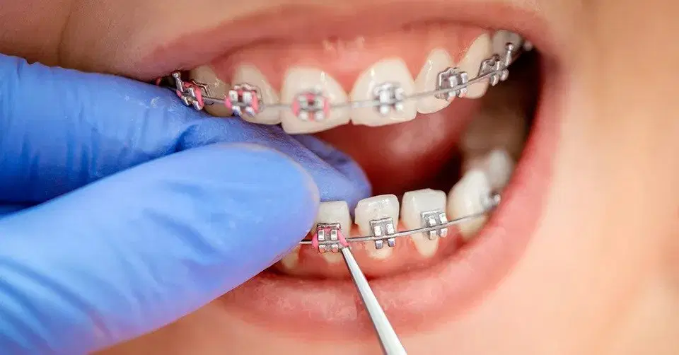What is the fastest orthodontics?