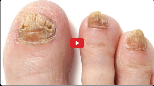 Toenail Fungus Laser Treatment: Important Facts About Getting Toenail Fungus Laser Treatment.