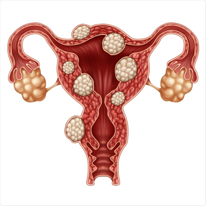 Fibroid Pain-related Tips to Help Women