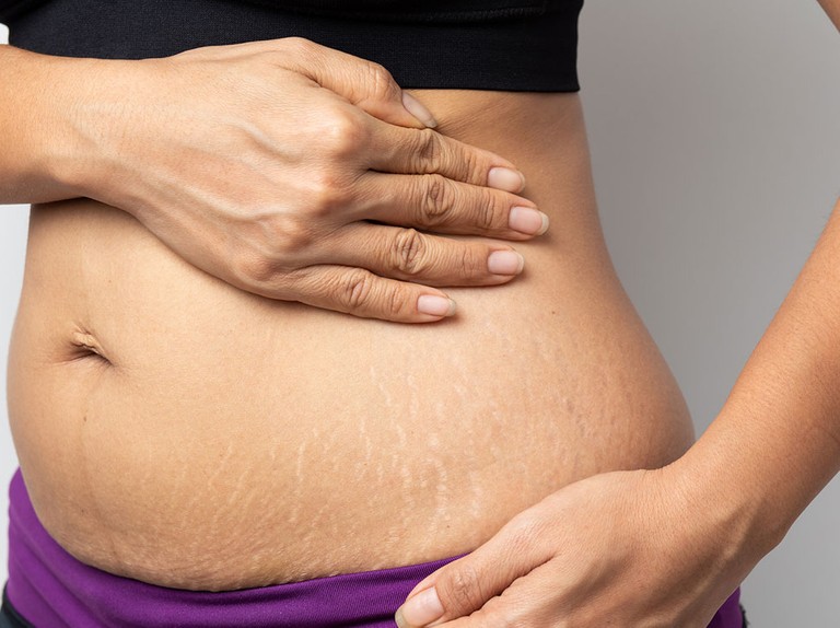 Stretch Marks in Pregnancy and Solutions