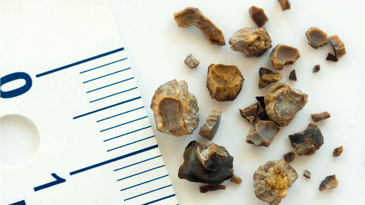 What Does a Kidney Stone Look Like?