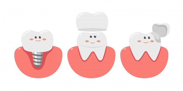 Same Day Crowns Roseville