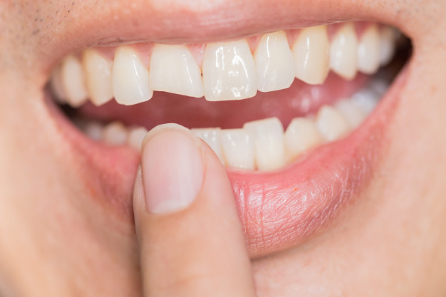 Trusted Dental Near Me - Know about Chipped Tooth