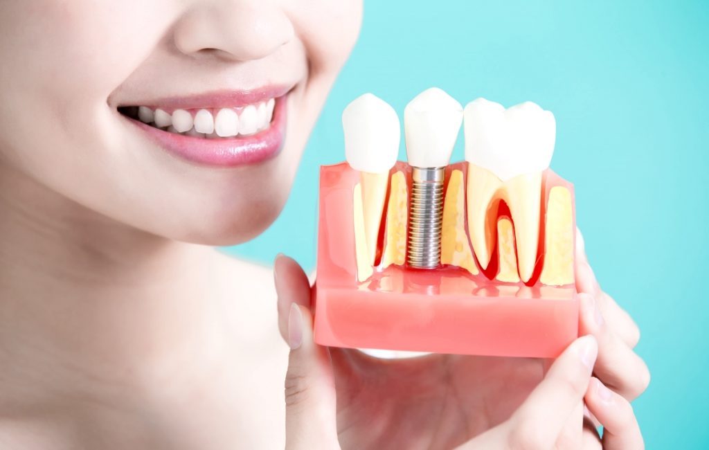 How Dental Implants Protect your Beautiful Smile?