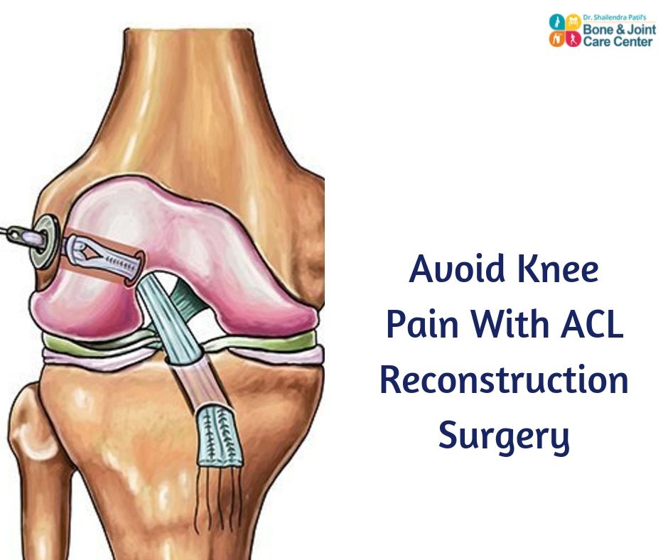 What Patient Say About ACL Reconstruction Surgery in Thane