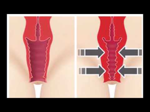 Laser Vaginal Tightening Treatment - Box Hill Superclinic