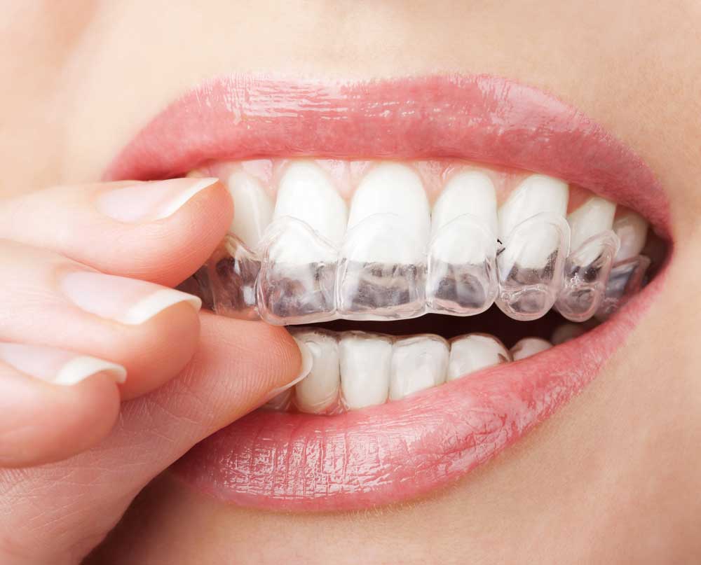 How Do Invisalign Aligners Work?
