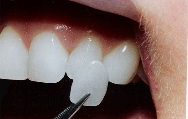 The Average Cost of Veneers