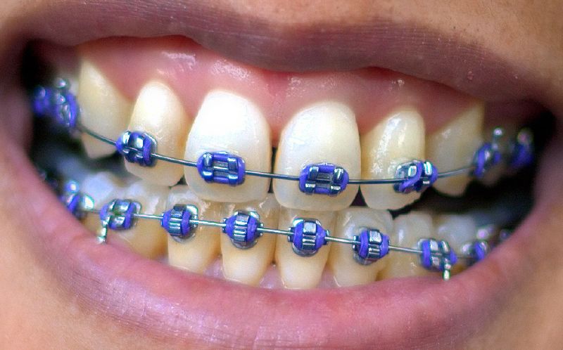 What Color Should I Get My Braces?