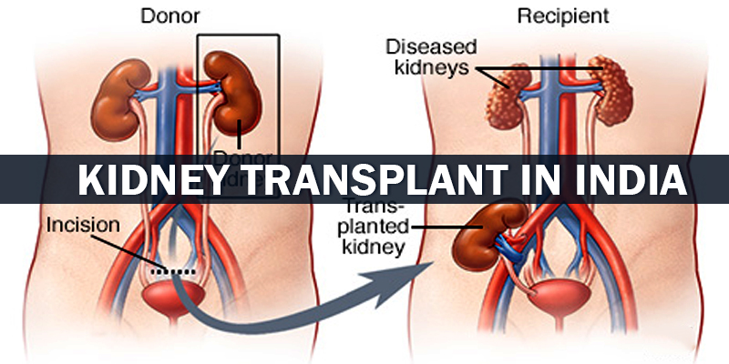 Kidney Transplant in India