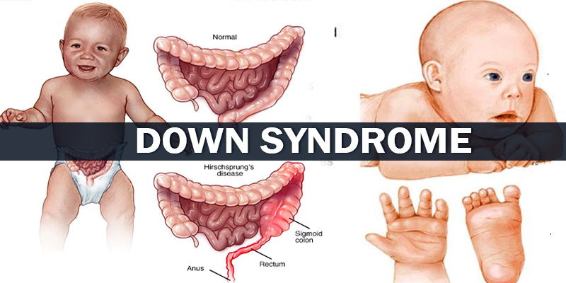 Down Syndrome