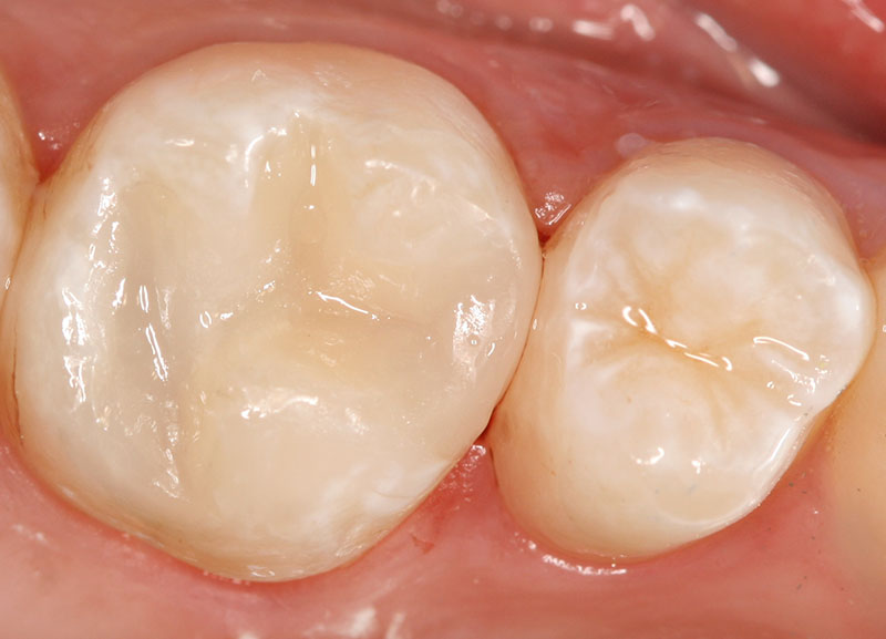 Lafayette Dental Implants