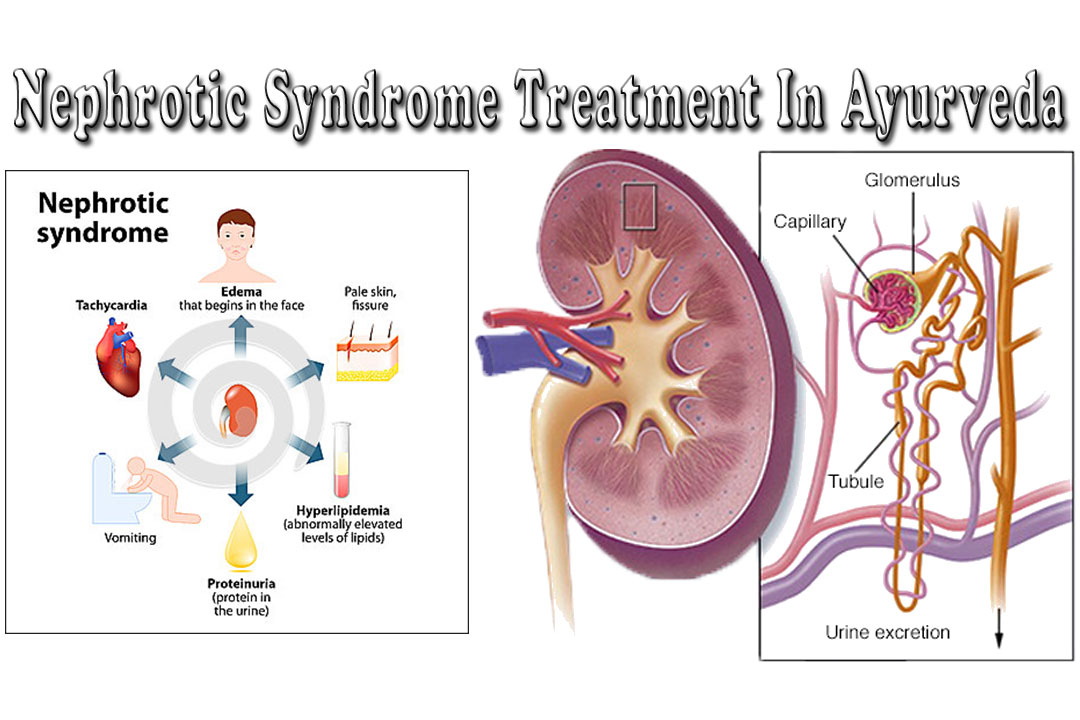 Are you in need of an effective Nephrotic Syndrome Ayurvedic treatment?