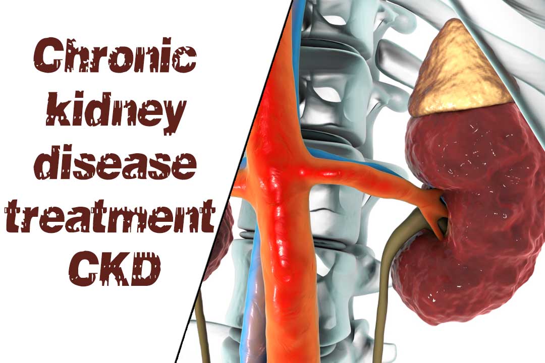 Why people should utilize Ayurvedic medicines for CKD treatment more than Allopathy?