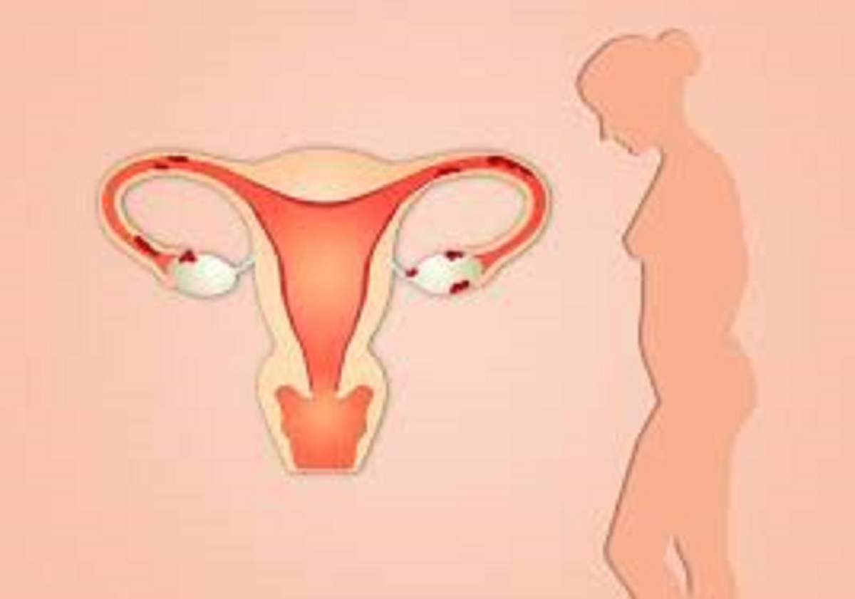 Hysterectomy — what does it entail?
