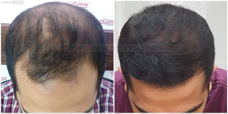 Treatment Options in Advanced Grade Baldness