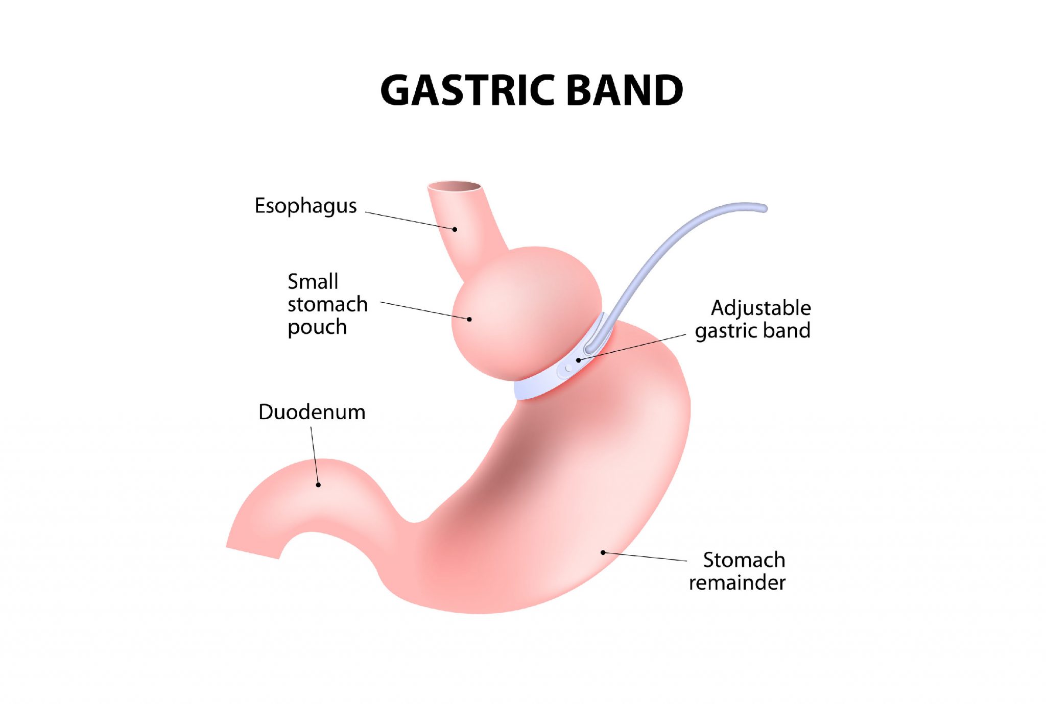 Lap Band Surgery: An Effective Solution for Weight Loss