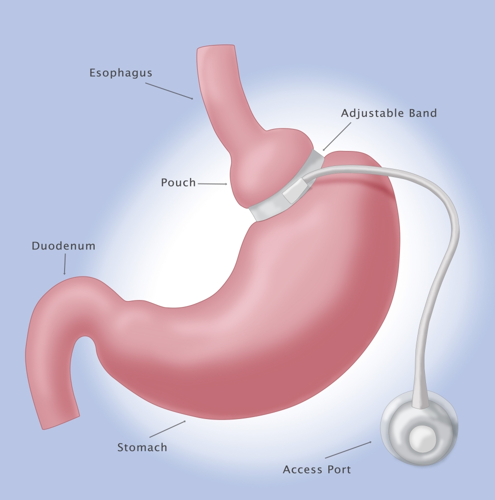 Slimming Success: Lifesaving Benefits Of Lap Band Surgery