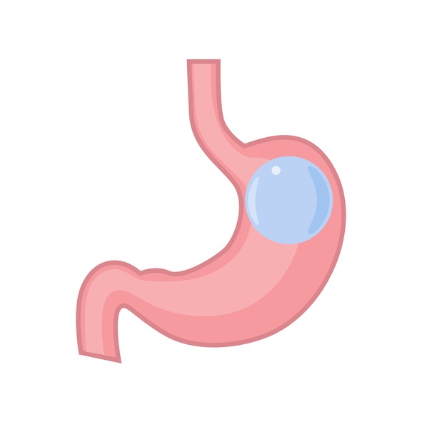 Is the Orbera Balloon Worth the Cost to Lose Weight?