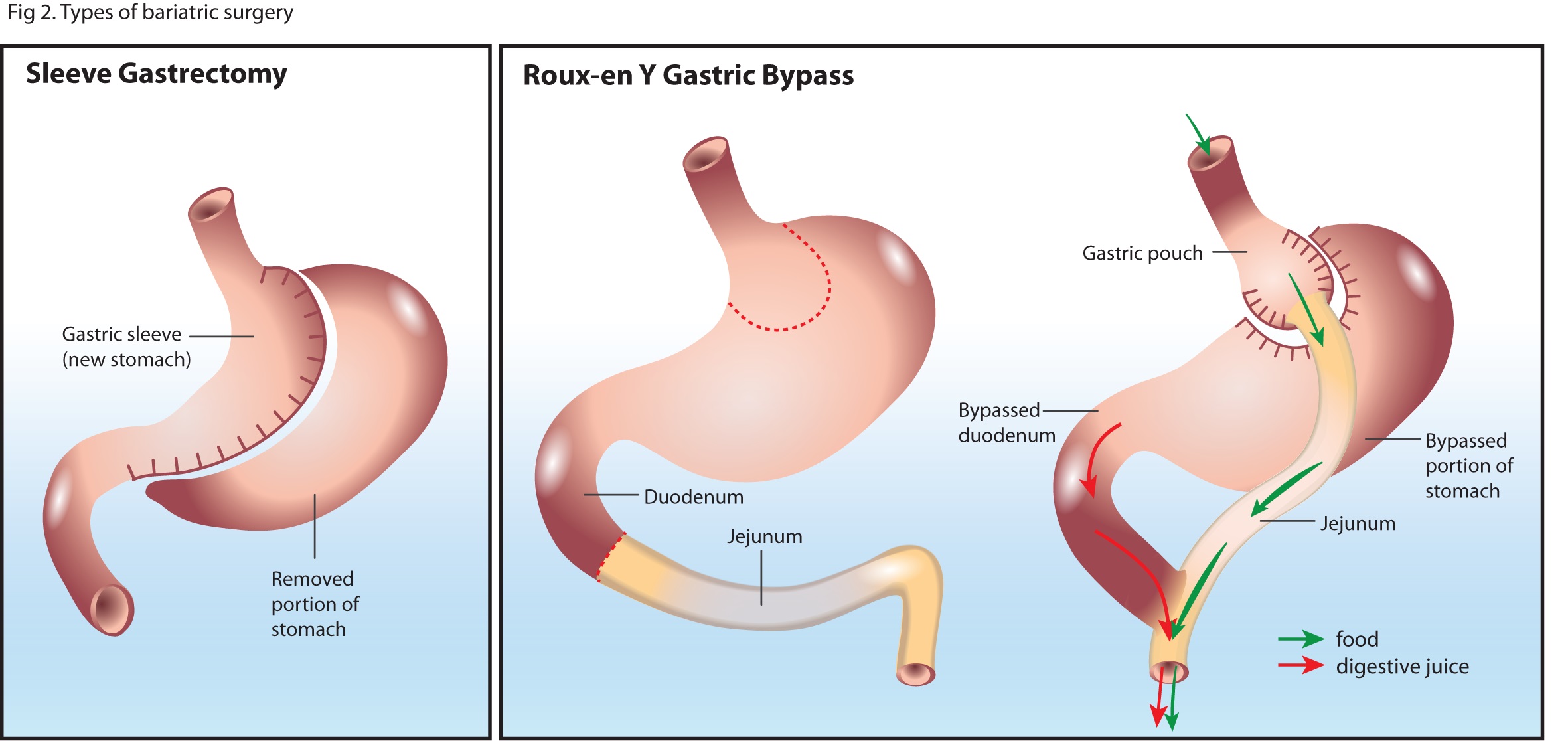 How Gastric Balloons Can Jumpstart Your Weight Loss Journey?