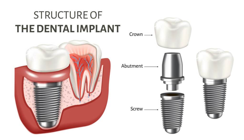 Why are dental implants the most suitable option for tooth replacement?