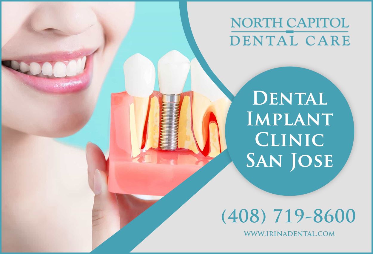 Best Dental Implant Dentist | North Capitol Dental Care