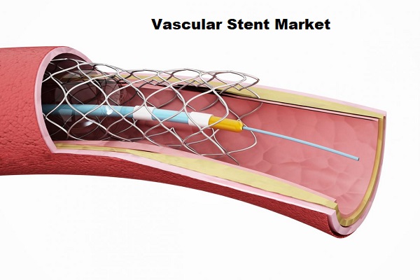 Vascular Stent Market To Garner Overwhelming Hike In Revenues By 2023