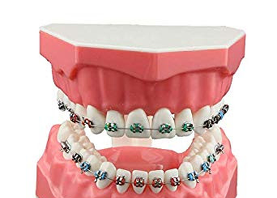 ORTHODONTIC BRACKETS