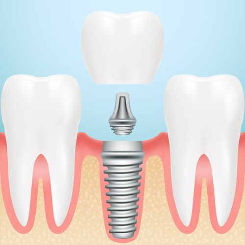 Dental Implants Haverhill MA