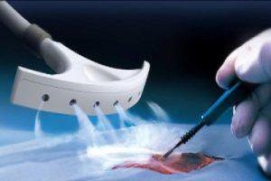 Smoke-Evacuation-System-Market Growth 2019-2024