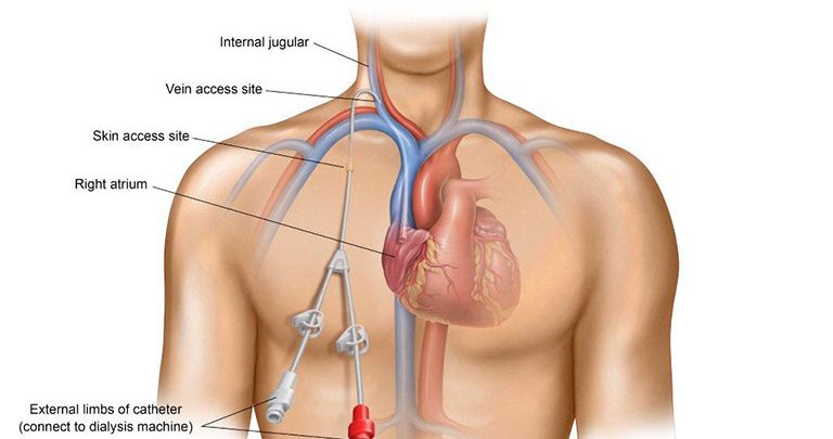 Central Vascular Access Device Market Growth 2019-2024