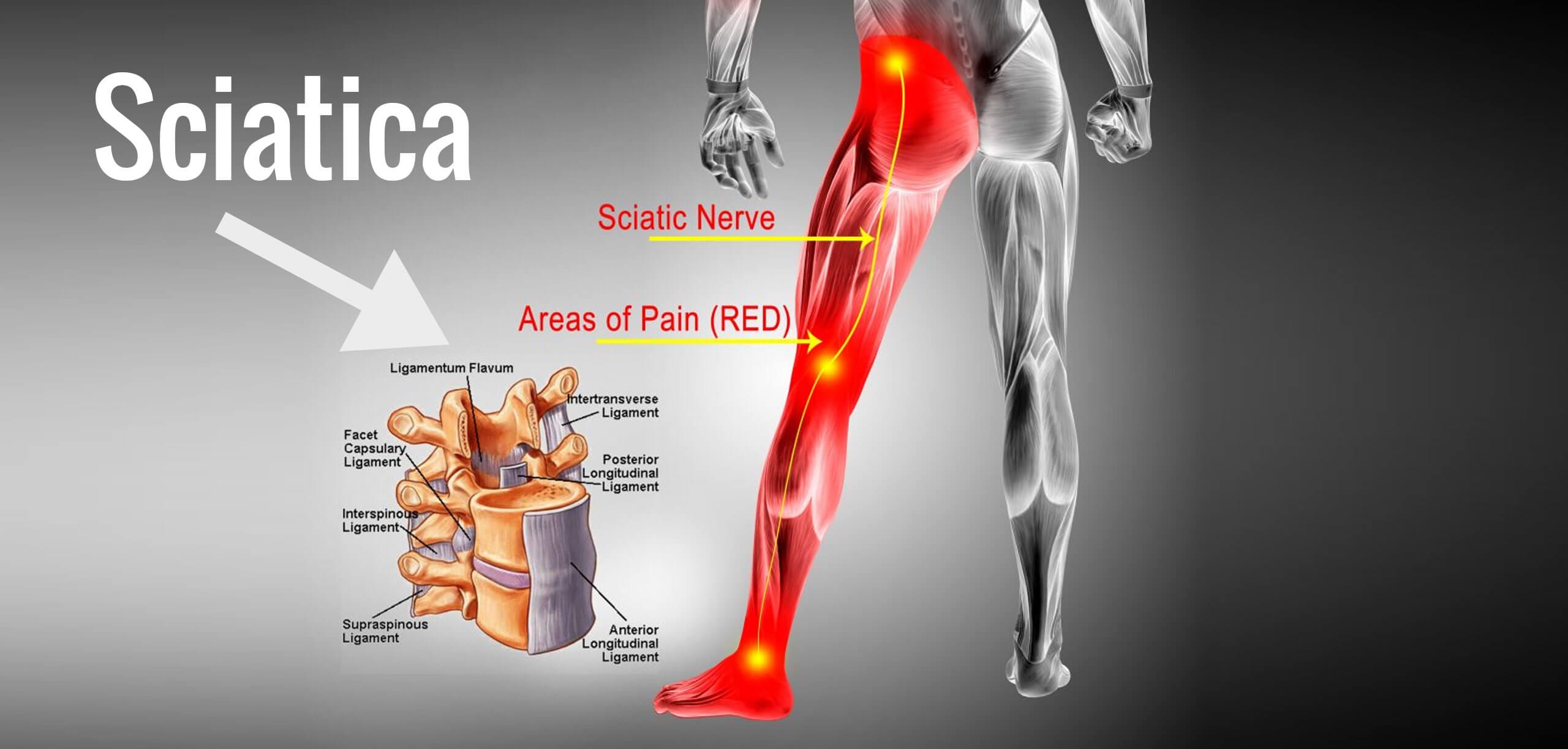 All You Need to Know About Sciatica Pain Relief MD!