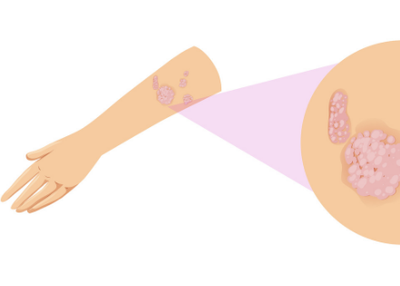 Psoriasis : Causes, Symptoms and Treatment