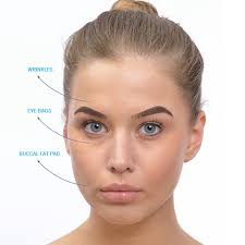 Who is eligible for Dark circle treatment and when is the treatment done?