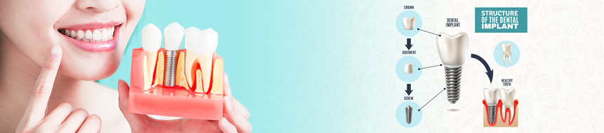 Dental Implant Treatment in Hyderabad