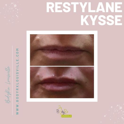 Restylane Kysse | BodyRx Louisville
