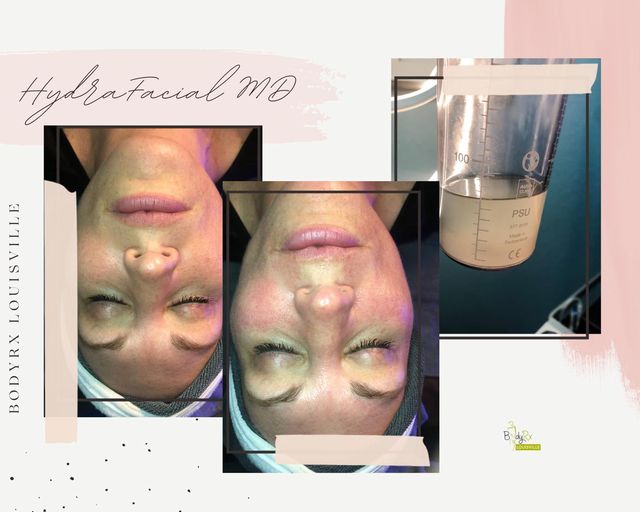 Face fillers Louisville USA