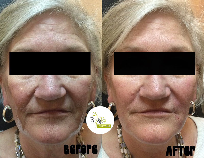 Skin treatment cost Louisville 