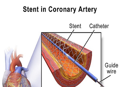 Percutaneous Coronary Intervention (PCI) Market Size Anticipated To Reach USD 15.20 Billion With 7.1% CAGR By 2023 | Emerging Trends, Share Analysis and Future Insights