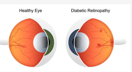 What is diabetic eye disease?