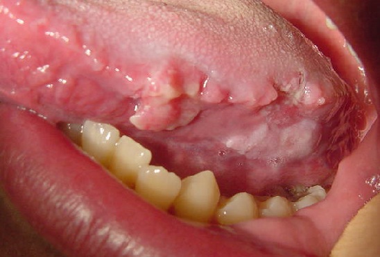 Oral cancer treatment in Delhi
