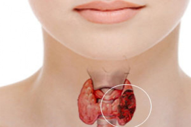 Thyroid Disease Surgeon in Delhi