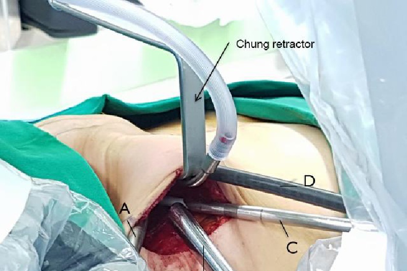 Robotic Thyroid Surgeon in Noida