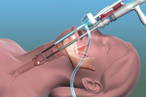 Robotic Thyroid Surgeon in Noida