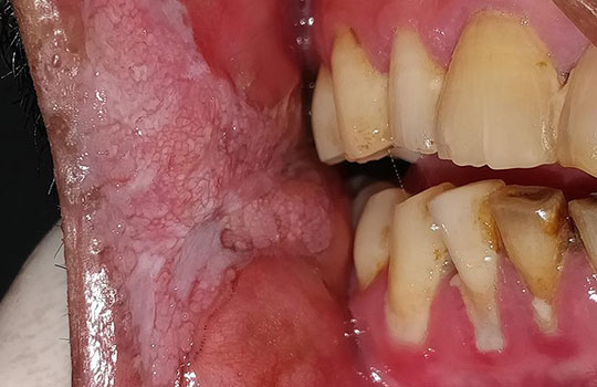 Mouth Cancer Consultant in India aims at eliminating cancer once and for all