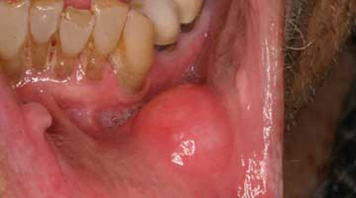 Oral cancer Treatment in Delhi